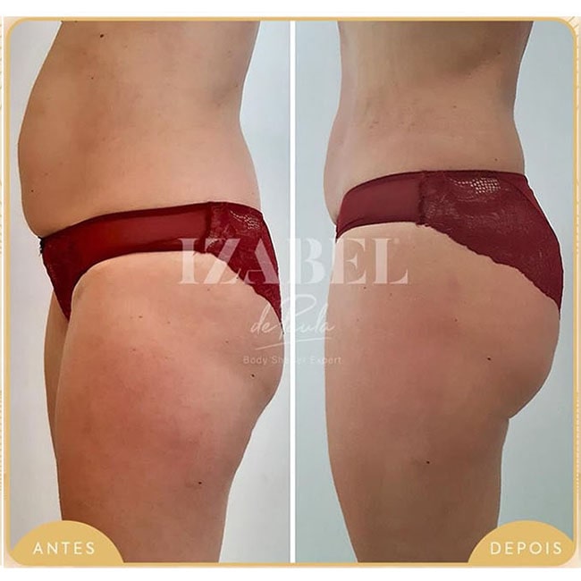 Kit Celulite Lipedema - Cápsulas e Gel para circulação e retenção líquidos antes e depois