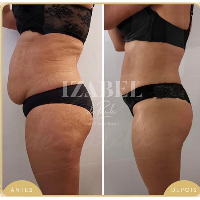 Resultado de antes e depois do kit Lipedema, Celulite
